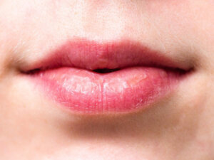 droge lippen Winterkwaaltjes - droge lippen